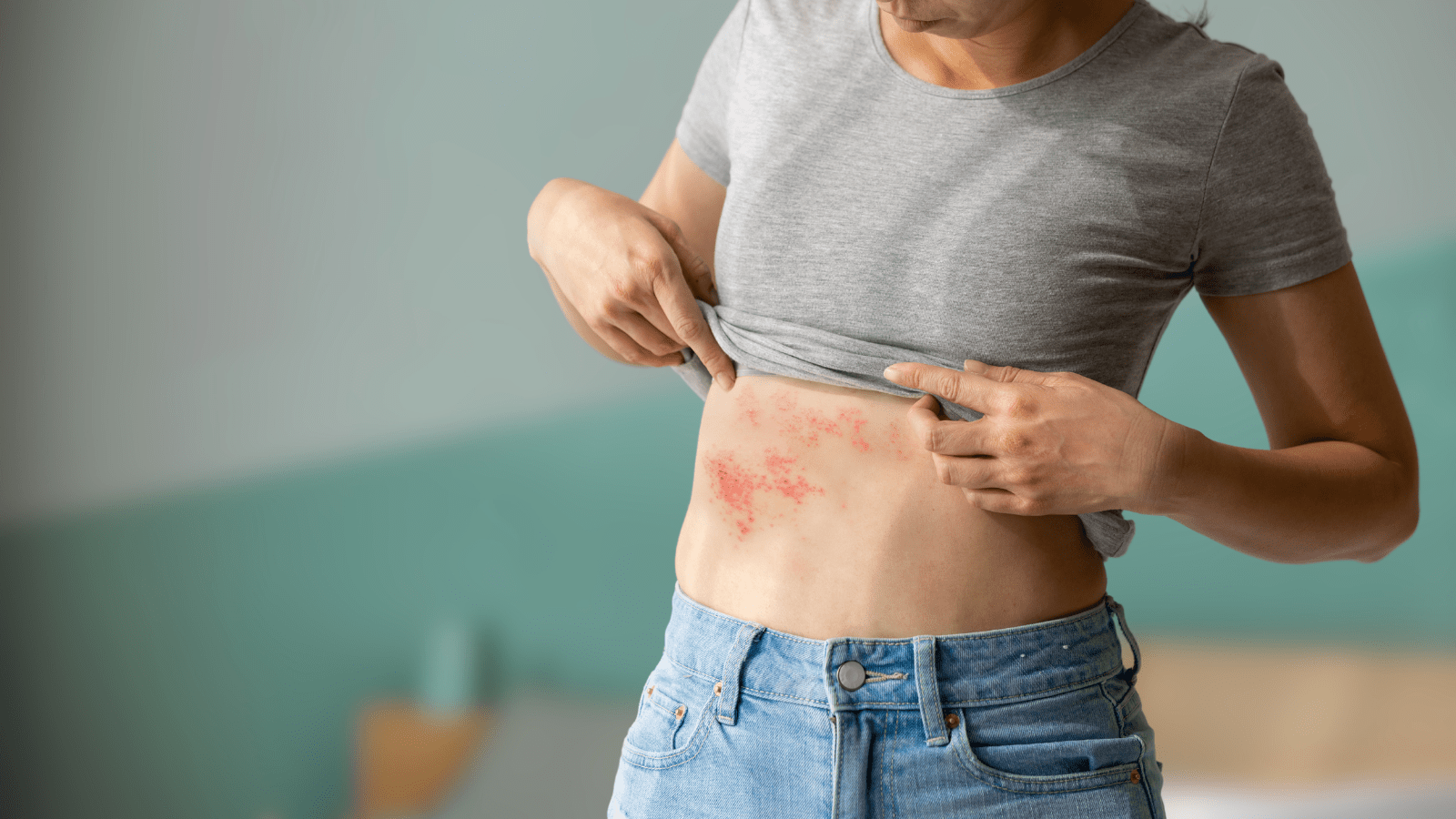 Shingles
